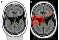 یه تحقیق جدید نشون میده که وقتی بد می‌خوابید، مغزتون پیرتر به نظر میاد
